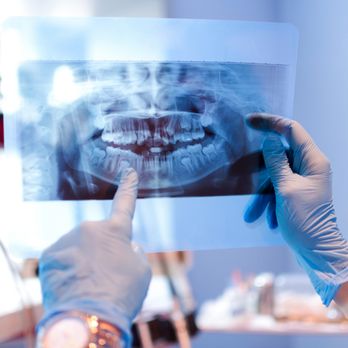 Titanium Dental Implants and Periodotics - Periodontists Near Me - Duluth, Georgia