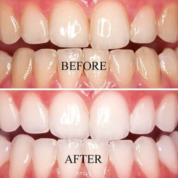 We Whiten LA - We whiten La , Laser whitening service - Teeth Whitening Near Me