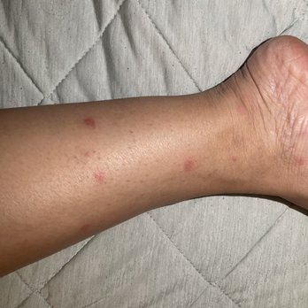 Sonesta Silicon Valley - Left foot, as you can see in the picture this is what happen when i left at the hotel. - Hotels Near Me - Milpitas, California Sonesta Silicon Valley - Left foot, as you can see in the picture this is what happen when i left at the hotel. - Hotels Near Me - Milpitas, California