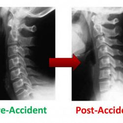 Harlingen Chiropractic Accident & Injury Clinic - Neck pain and headaches can be caused by spinal problems.
