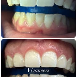 The Attentive Dentist - Conservative smile makeover. Patient left so happy.