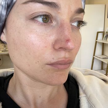 Seoul Medspa - Damage to my skin from unwarned needle used for extractions. - Medical Spas Near Me - Garden Grove, California Seoul Medspa - Damage to my skin from unwarned needle used for extractions. - Medical Spas Near Me - Garden Grove, California