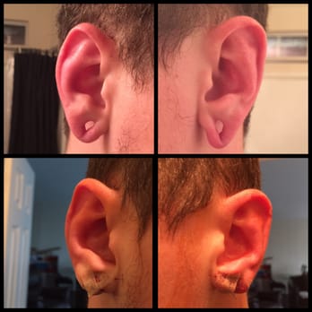 Correa Plastic Surgery - My stretched lobes before surgery, and my lobes after surgery. I love my new appearance. Dr. Correa changed my life!!! - Plastic Surgeons Near Me - The Woodlands, Texas Correa Plastic Surgery - My stretched lobes before surgery, and my lobes after surgery. I love my new appearance. Dr. Correa changed my life!!! - Plastic Surgeons Near Me - The Woodlands, Texas