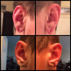 Correa Plastic Surgery - My stretched lobes before surgery, and my lobes after surgery. I love my new appearance. Dr. Correa changed my life!!!