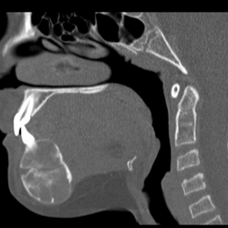 Beverly Hills Oral Surgery - Giant cell  tumor 6 months post treatment with intralesional injections and calcitonin lesion resolving