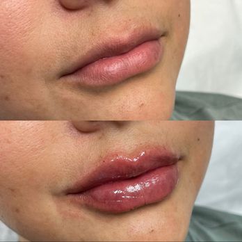 Fixation Med Spa - Lip Filler - Laser Hair Removal Near Me - Rancho Cucamonga, California Fixation Med Spa - Lip Filler - Laser Hair Removal Near Me - Rancho Cucamonga, California