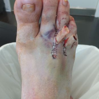 Henry Tseng, DPM - 5 days after nerouma surgery before Dr tseng removed the two drains from my foot. - Podiatrists Near Me - West Covina, California Henry Tseng, DPM - 5 days after nerouma surgery before Dr tseng removed the two drains from my foot. - Podiatrists Near Me - West Covina, California
