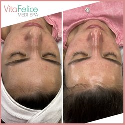 Vita Felice Medi Spa - Chemical Peel before and after