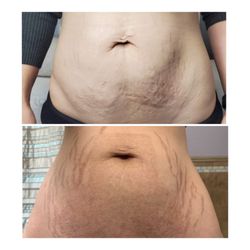 The Touch - Plasma Skin Tightening Abdomen treatment - Before  5 weeks healed