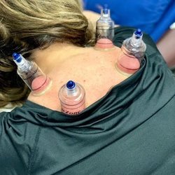 We now also offer Myofascial Cupping for soft tissue cupping decompression.  Cupping has become a very popular treatment to d...