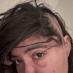Adi Iyer, MD, MS - A few days after my first surgery in April 2023