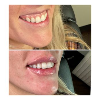 The Perfect Secret - Lip Rejuvenation - Medical Spas Near Me - Scottsdale, Arizona The Perfect Secret - Lip Rejuvenation - Medical Spas Near Me - Scottsdale, Arizona