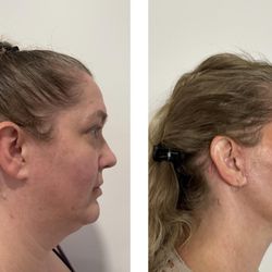 Skin And Face Phoenix - Before and After Face+Neck Lift, Upper and Lower Blepharoplasty