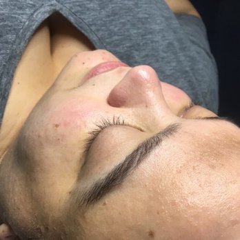 Elite Styles Salon & Med Spa - Skin (after)... I wish I could've taken a before picture of my nose or at least a more close up of my face. - Hair Salons Near Me - Miami, Florida