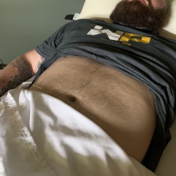 Peace Within Acupuncture - Me getting acupuncture. - Acupuncture Near Me