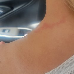 Elite Skin Rejuvenation Day Spa - Burn from neck wrap