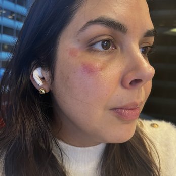 Elite Facials - Day after facial. Looking bad, feeling bad, and couldn't sleep right since it was stinging. - Skin Care Near Me - Orinda, California
