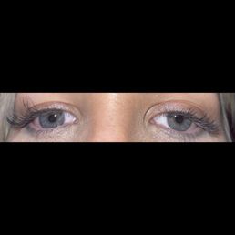 Half of eyelashes fallen off from one eye? Half of eyelashes fallen off from one eye?