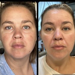 ZO Skin Centre Beverly Hills - 4 weeks of using ZO skin care