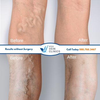 USA Vein Clinics - Results without surgery - Radiologists Near Me - Tamarac, Florida USA Vein Clinics - Results without surgery - Radiologists Near Me - Tamarac, Florida