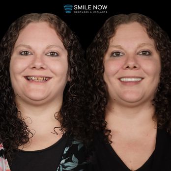 Smile Now Boise Dentures and Implants - Cosmetic Dentists Near Me - Eagle, Idaho Smile Now Boise Dentures and Implants - Cosmetic Dentists Near Me - Eagle, Idaho