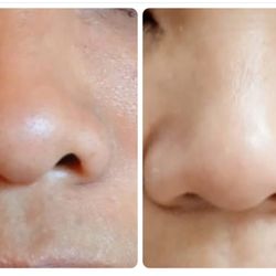Royal Oasis Spa - Blackheads (Form of Acne)