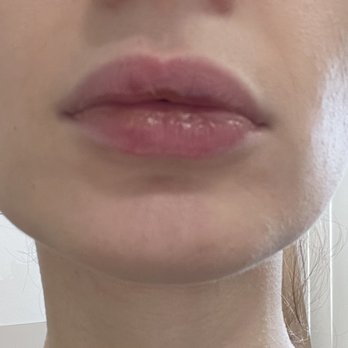 Oceana Dermatology - After - Dermatologists Near Me - Carlsbad, California Oceana Dermatology - After - Dermatologists Near Me - Carlsbad, California