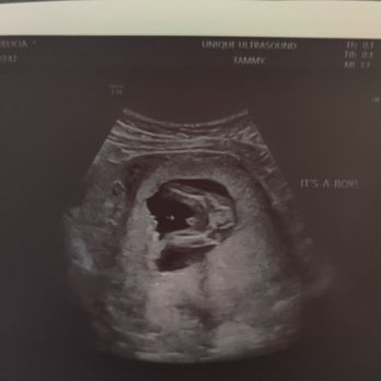 Unique Ultrasound - It's a boy!!! Exactly what we wanted. - Diagnostic Imaging Near Me - Temecula, California Unique Ultrasound - It's a boy!!! Exactly what we wanted. - Diagnostic Imaging Near Me - Temecula, California