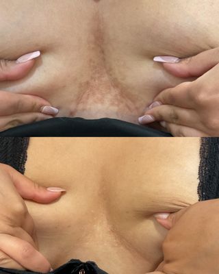 Lights, Lasers, Microneedling & Morpheus8 - before and afters of morpheus8, lights (IPL), and lasers! Lights, Lasers, Microneedling & Morpheus8 - before and afters of morpheus8, lights (IPL), and lasers!