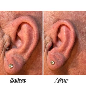 Wildly Aesthetics - Ear wax - Skin Care Near Me - Jackson, California Wildly Aesthetics - Ear wax - Skin Care Near Me - Jackson, California