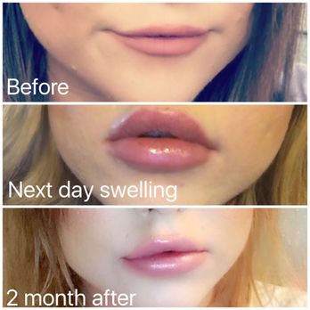 Texas Laser & Aesthetics Training Academy - Austin did my lips and he did an amazing job. - Cosmetology Schools Near Me - Austin, Texas Texas Laser & Aesthetics Training Academy - Austin did my lips and he did an amazing job. - Cosmetology Schools Near Me - Austin, Texas