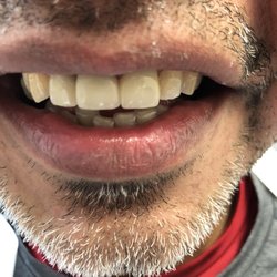 David Guyot, DDS - Tustin Smiles - Perfect crowns and perfect shade...happy patient