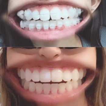Simply Orthodontics - March 2018 top is the day I got them on.  Dec 2018 bottom is the day I got them off. - Orthodontists Near Me - Irvine, California