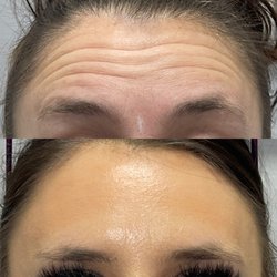 Aesthetica - Botox