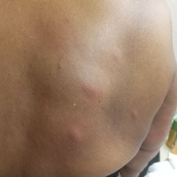 Bed bug bites?!? Bed bug bites?!?