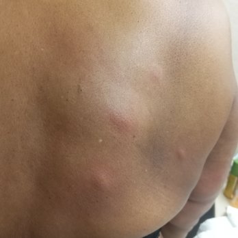 Hampton Inn Selma - Bed bug bites?!? - Hotels Near Me - Selma, Alabama Hampton Inn Selma - Bed bug bites?!? - Hotels Near Me - Selma, Alabama