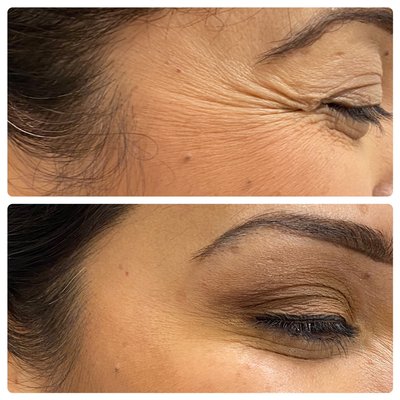 Botox - At Sahar Allure Med Spa, we believe people truly look their best when they feel their best. Sahar Alnsour RN has a passion for changing lives, and she can't wait to make a difference in yours! Through Advanced Skin Care Technology, Dermal Fillers, Medical Grade Facials, Laser Hair Removal, Vitamin IV Therapy and more, we are giving your skin a glowing, more youthful look. All of our treatments are backed by science, and our in-house doctor oversees your skin's health throughout your whole journey, ensuring that it stays radiant! So come on down, sit back, and relax -- we'll make you feel beautiful inside and out! We look forward to seeing you soon! Botox - At Sahar Allure Med Spa, we believe people truly look their best when they feel their best. Sahar Alnsour RN has a passion for changing lives, and she can't wait to make a difference in yours! Through Advanced Skin Care Technology, Dermal Fillers, Medical Grade Facials, Laser Hair Removal, Vitamin IV Therapy and more, we are giving your skin a glowing, more youthful look. All of our treatments are backed by science, and our in-house doctor oversees your skin's health throughout your whole journey, ensuring that it stays radiant! So come on down, sit back, and relax -- we'll make you feel beautiful inside and out! We look forward to seeing you soon!