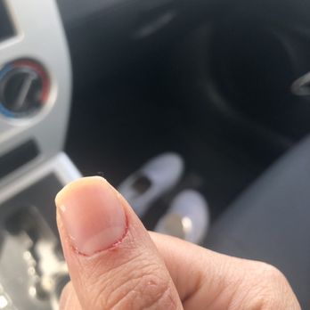 Vinny Nails Spa - Bloody finger from cuticle cutting at Vinny's Nail & Spa. - Nail Salons Near Me - Palm Desert, California Vinny Nails Spa - Bloody finger from cuticle cutting at Vinny's Nail & Spa. - Nail Salons Near Me - Palm Desert, California