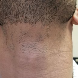 After one hair removal session... Amazing After one hair removal session... Amazing