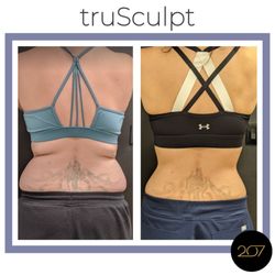 207 Laser & Integrative MED - TruSculpt iD® is the most advanced body sculpting, or fat reduction device on the market.