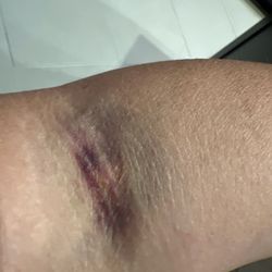 Sonora Quest Laboratories - One of two bruises due to the incompetence of the phlebotomist.