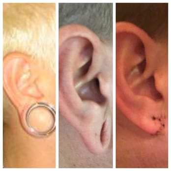 Ronald J Edelson, MD - So in love with my new ear lobes! Dr. Edelson and staff did an awesome job and I couldn't be more satisfied. Thank you so much! - Cosmetic Surgeons Near Me - San Diego, California Ronald J Edelson, MD - So in love with my new ear lobes! Dr. Edelson and staff did an awesome job and I couldn't be more satisfied. Thank you so much! - Cosmetic Surgeons Near Me - San Diego, California