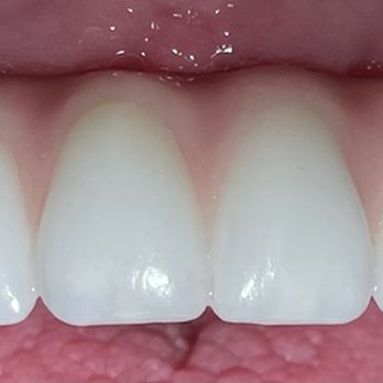 David W Epstein, DDS - Implant supported bridge not removable - Oral Surgeons Near Me - Novato, California