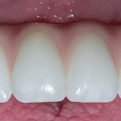 David W Epstein, DDS - Implant supported bridge not removable