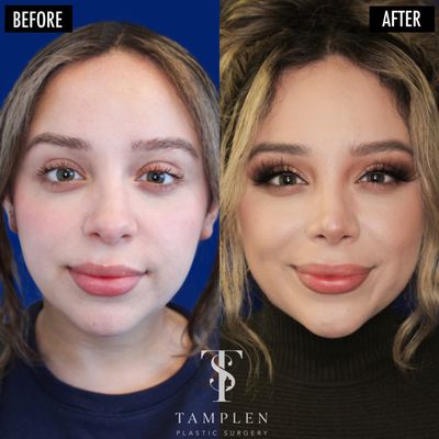 Buccal Fat Removal - Amazing result just 3 months after Buccal Fat Removal, Jaw Contouring Liposuction, and Rhinoplasty Buccal Fat Removal - Amazing result just 3 months after Buccal Fat Removal, Jaw Contouring Liposuction, and Rhinoplasty
