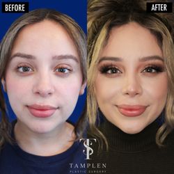 Tamplen Plastic Surgery  - Amazing result just 3 months after Buccal Fat Removal, Jaw Contouring Liposuction, and Rhinoplasty