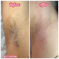 SF Sugaring - Armpit sugaring before and after