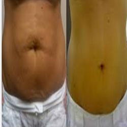 Medical Aesthetics Of New Jersey - Body wraps cover your body with a natural wrap made from pure ingredients to remove toxins and detox your body from harmful benefactors.