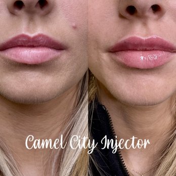 Camel City Injector - Lip Filler Before/After Camel City Injector - Medical Spas Near Me - King, North Carolina