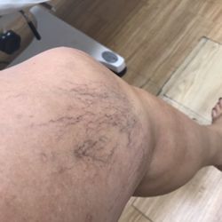Skin Beauty Laser Center - Before - Left Leg - January